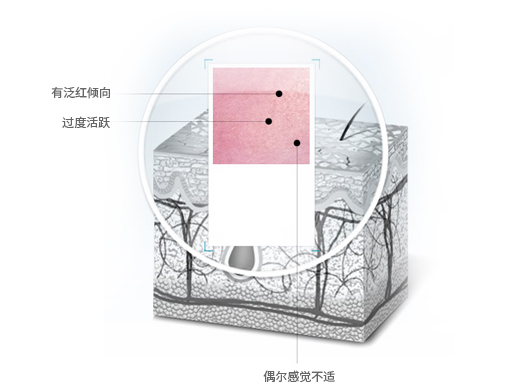 敏感性皮膚